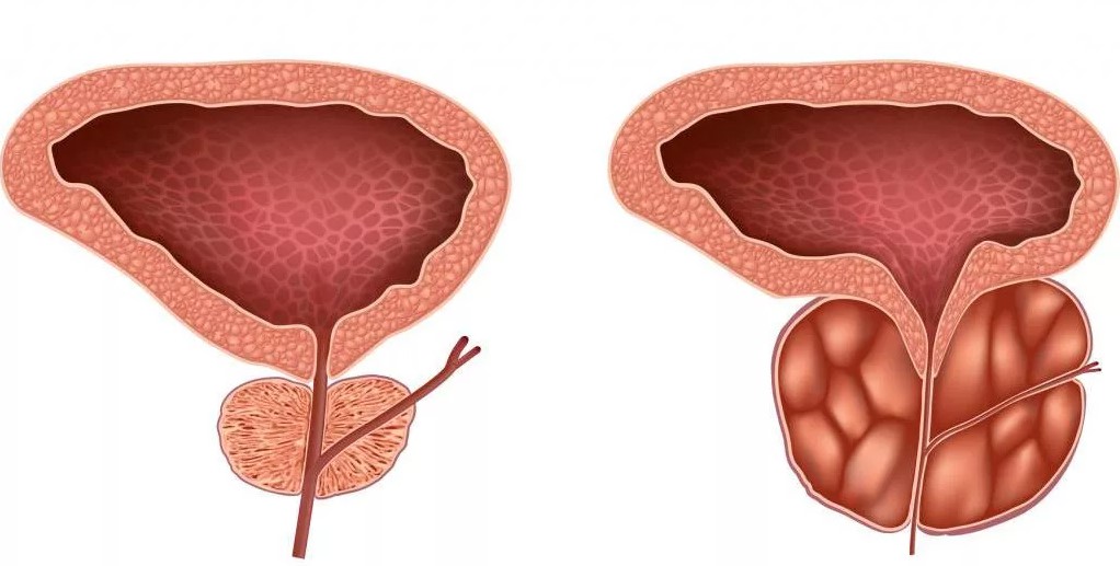 Menjalani Aktivitas Sehari-hari dengan Penyesuaian yang Lebih Bijak